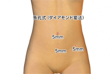 多孔式（ダイアモンド変法）