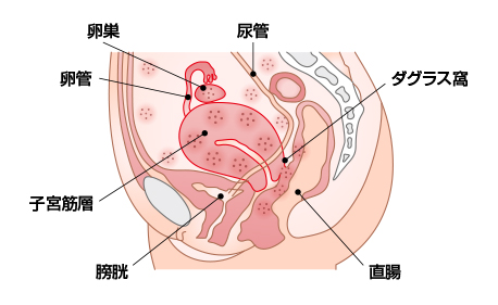 他臓器子宮内膜症