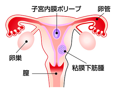 子宮鏡手術を行う病気